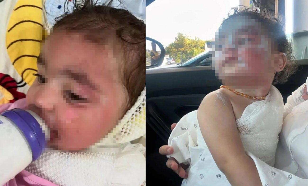 Kreşte facia: Okul 'Türk kahvesi döküldü' dedi aile inanmadı: Yanıklar çok daha derin...