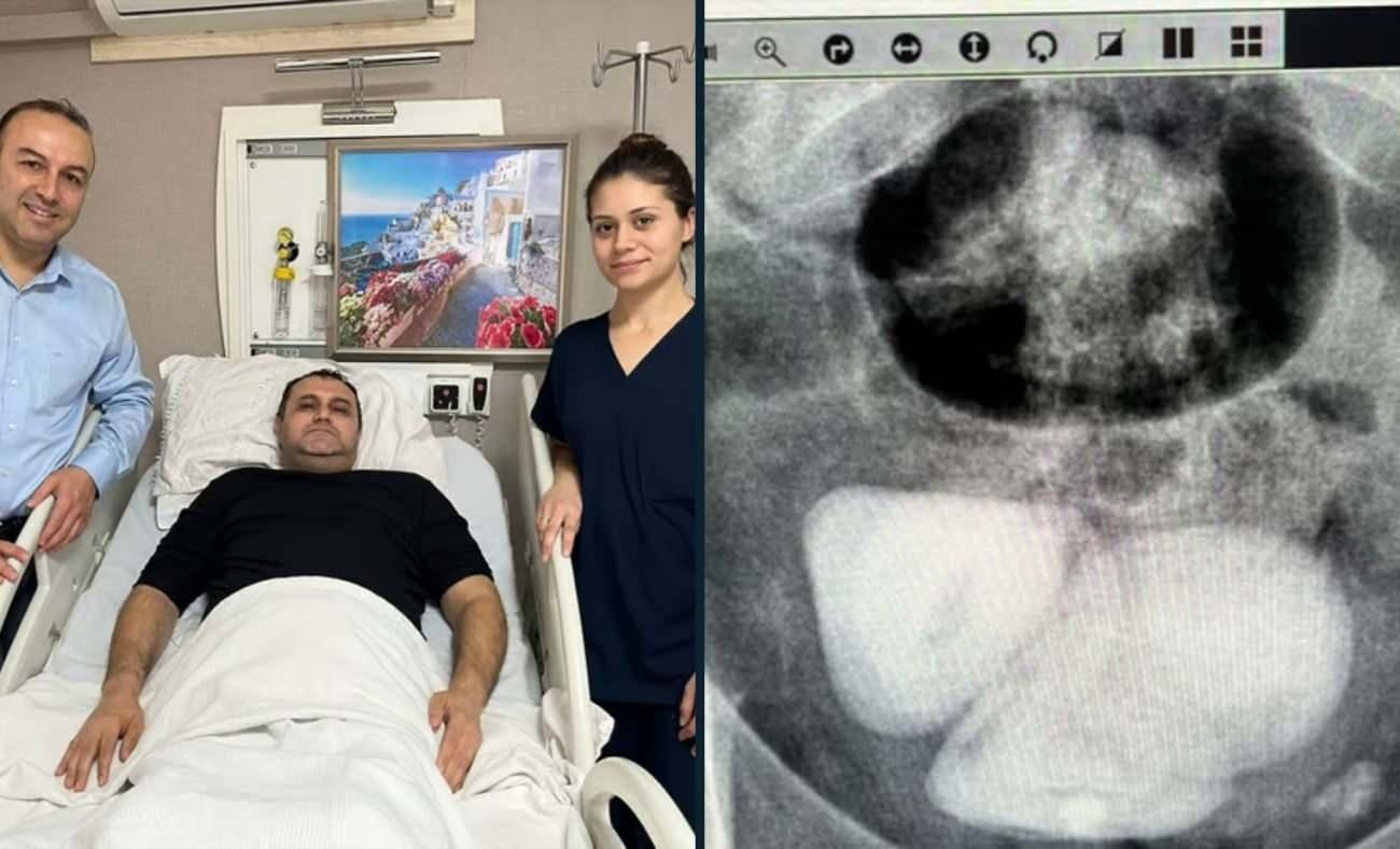 Aydın'da şoke eden olay! Mesanesinden resmen piramit şeklinde taş çıktı
