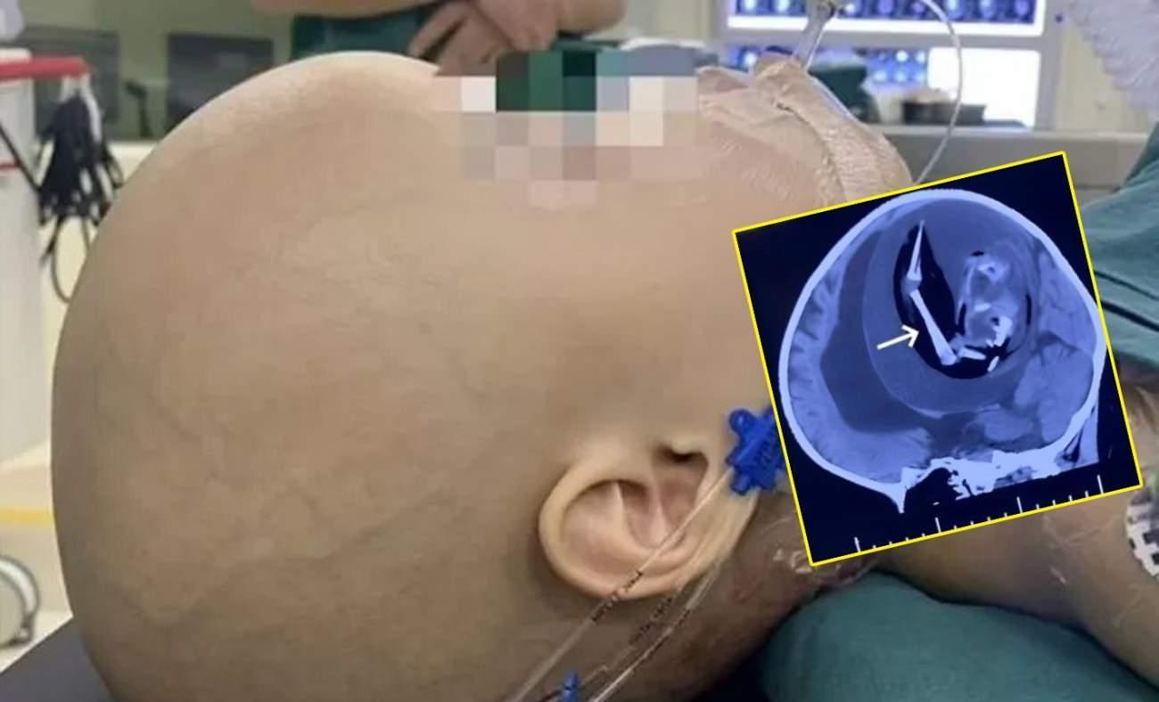 Kafatası hızla b&uuml;y&uuml;yordu! Bebeğin kafasından &ccedil;ıkana doktorlar bile inanamadı