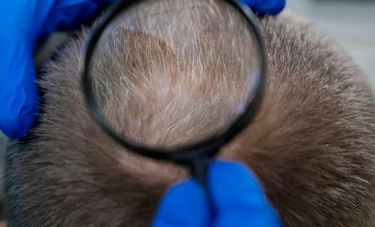 Erkek tipi sa&ccedil; d&ouml;k&uuml;lmesinde &ccedil;ığır a&ccedil;an adım: Clascoterone!