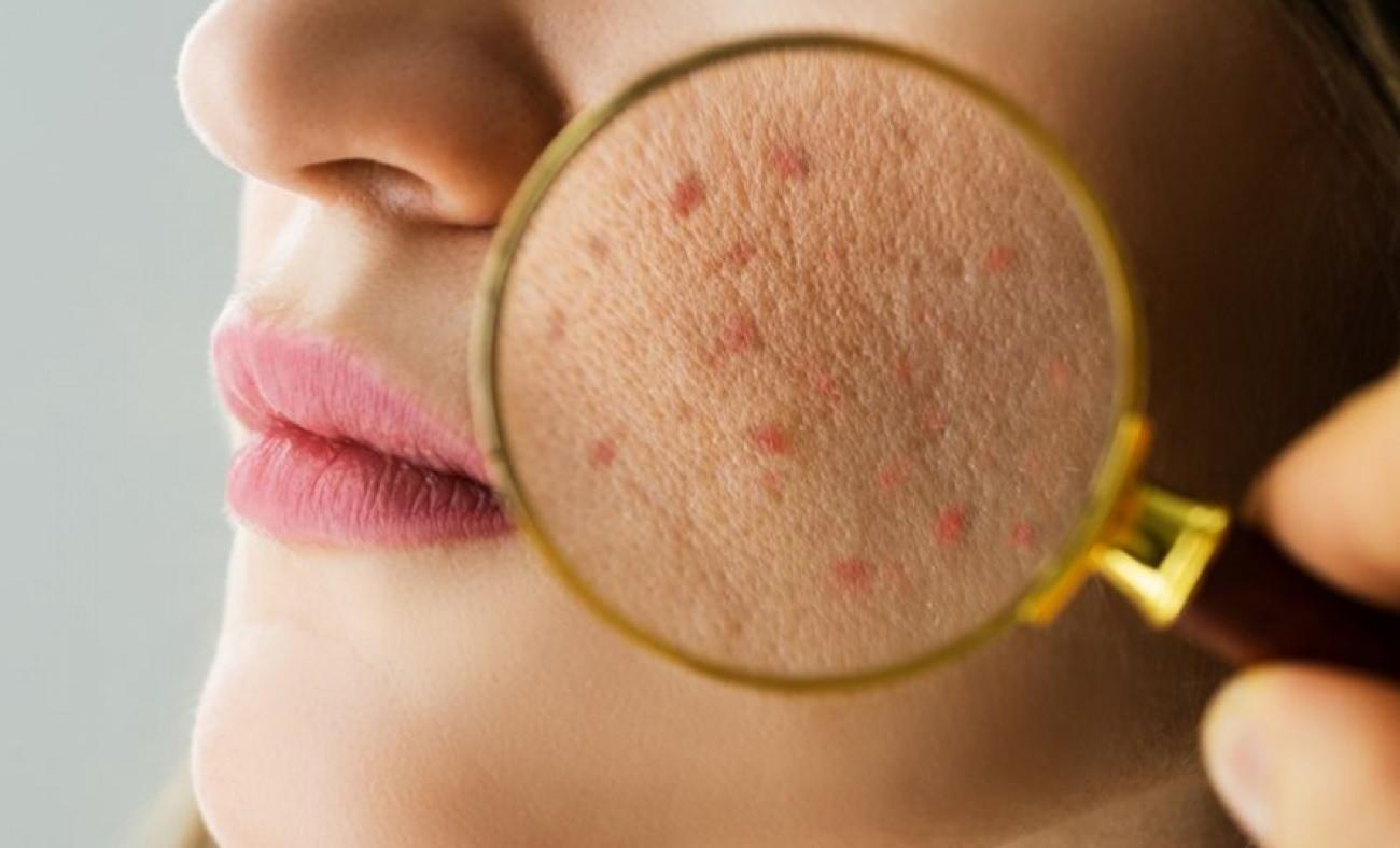 Yetişkinlerde akne alarmı: Uzman isim tetikleyen fakt&ouml;rleri sıraladı