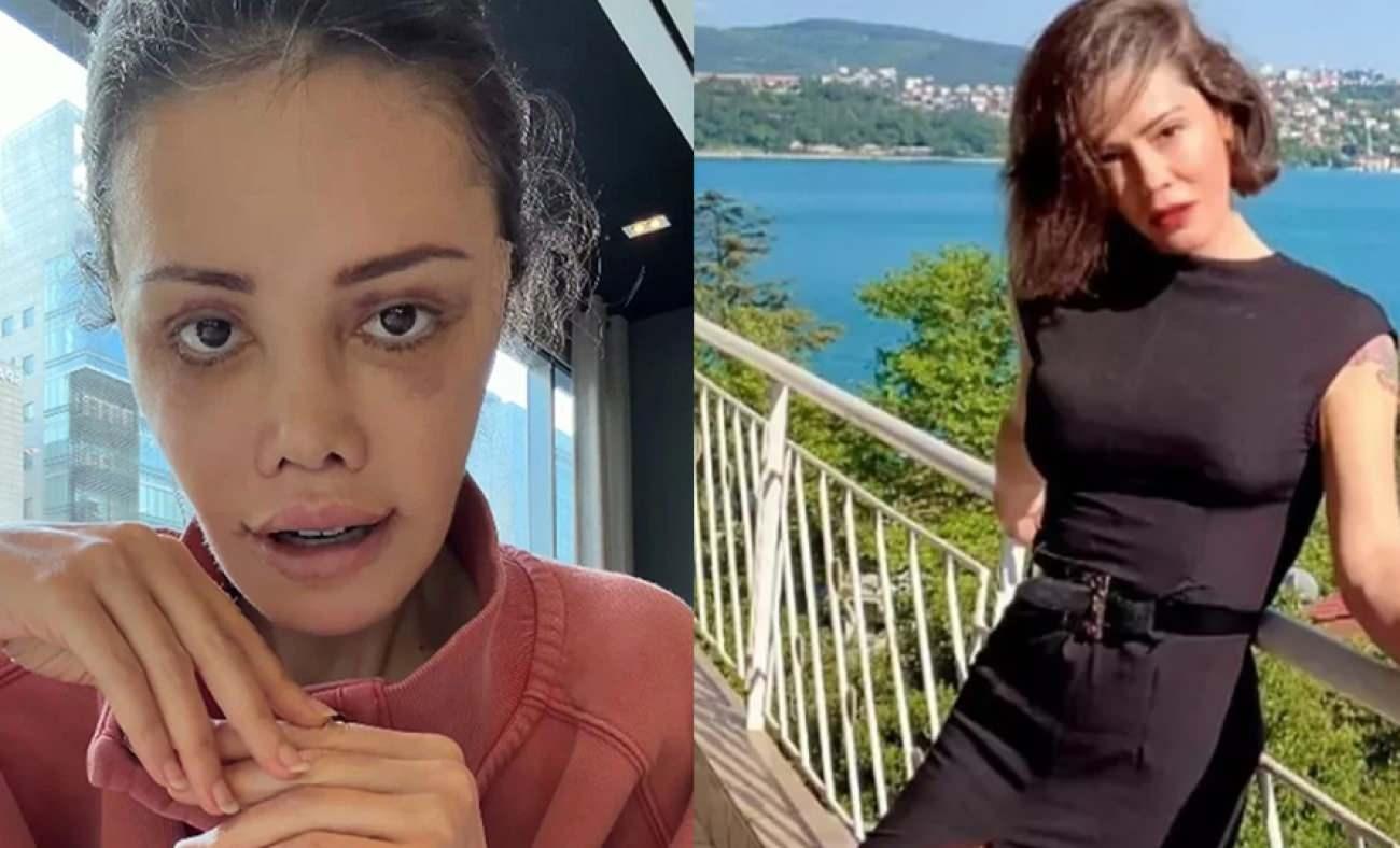Y&uuml;z nakli sonrası kaşında sa&ccedil; &ccedil;ıktı! Didem Ceran'dan şaşırtan paylaşım