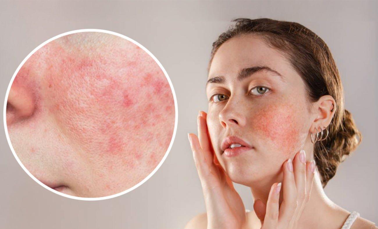 G&uuml;l hastalığı sandığınızdan daha yaygın: G&uuml;l hastalığının ilk belirtileri nelerdir?