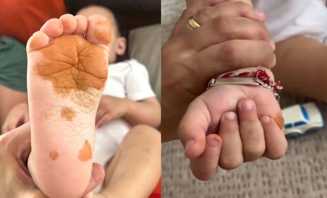 Sosyal medyada g&uuml;ndem oldu! &Ccedil;ocuğunun el ve ayaklarındaki renk değişiminin nedeni şaşırttı