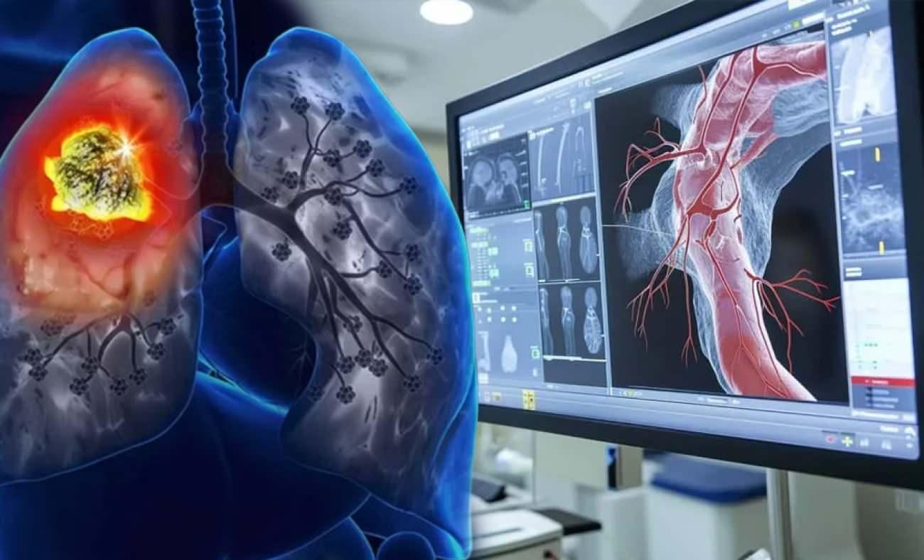 Kalp i&ccedil;in BT anjiyo &ccedil;ektirdi! Akciğerinde nadir g&ouml;r&uuml;len t&uuml;m&ouml;r ortaya &ccedil;ıktı