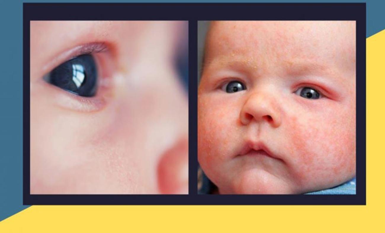 Bebeklerde göz kızarıklığı ve kaşıntı nedenleri! Bebeğinizin gözleri