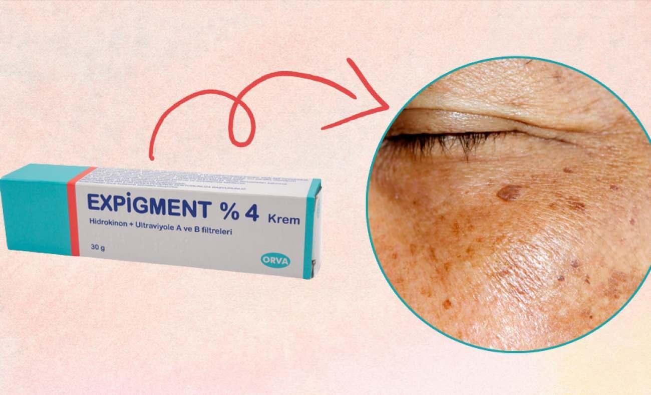 Expigment krem ne işe yarıyor? Expigment krem nasıl kullanılır ...