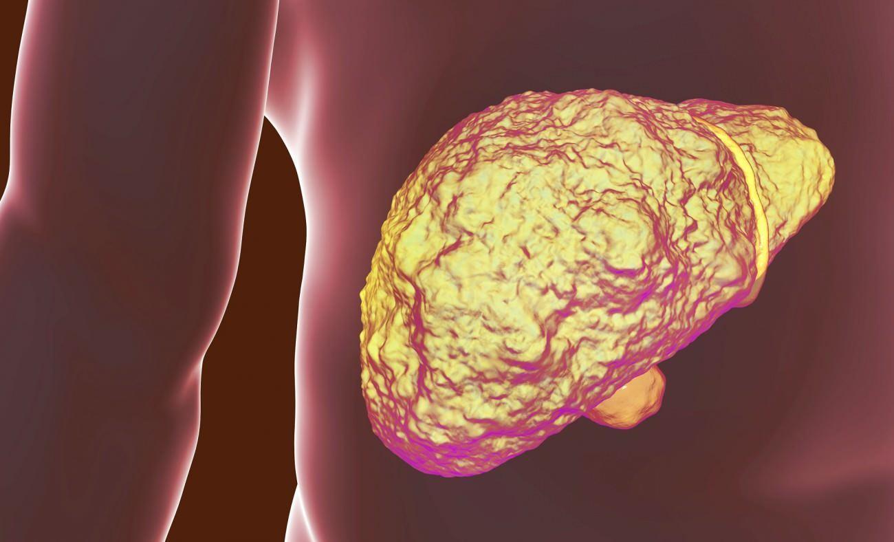 Siroz hastalığı nedir ve neden olur? Siroz belirtileri nelerdir? Sirozun tedavisi var mıdır Siroz hastalığı nedir ve neden olur? Siroz belirtileri nelerdir? Sirozun tedavisi var mıdır