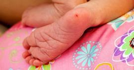 Bebeklerde topuk kanı neden alınır? Bebeklerde topuk kanı testi ile ilgili gerekenler