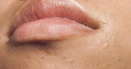 Dudak çevresinde sivilce neden çıkar? Perioral Dermatit nasıl tedavi edilir?