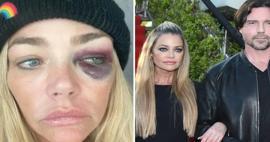 Gözleri mosmor olan Denise Lee Richards'tan eşine ağır suçlamalar: Beni öldürmeye çalıştı