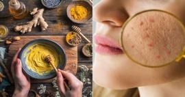 Zerdeçal ve bal maskesiyle aknelere son! Deneyenler çok beğendi