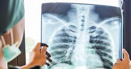 Tekrarlayan zatürreyi hafife almayın: Kanser belirtisi olabilir!