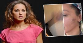 Yıldız Asyalı, 7 aylık eşi Mustafa Semih Demirci tarafından darp edildiğini açıkladı