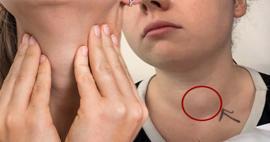 Yıllarca şikayetleri g&ouml;rmezden gelindi! Tiroid kanseri olduğunu arkadaşları fark etti
