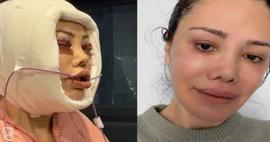 Y&uuml;z nakli ge&ccedil;irmişti! Didem Ceran k&ouml;t&uuml; haberi duyurdu