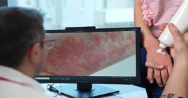 Uzman isim uyardı: Egzaması olan &ccedil;ocuklarda gereksiz diyet alerjiyi tetikleyebilir