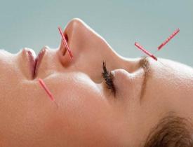 Akupunktur nedir? 