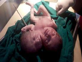 Hindistan'da iki başlı bebek doğdu