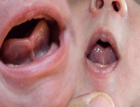 Bebeklerde dil bağı (Ankiloglossi) nedir? Dil bağı belirtileri ve tedavisi...