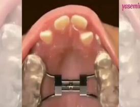Ortodontik tedavisinin muazzam etkisini bir de böyle görün