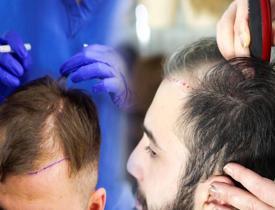 Saç dökülmesi tedavisinde saç ektirmek caiz mi? Protez saç nedir? Protez saç gusle engel mi