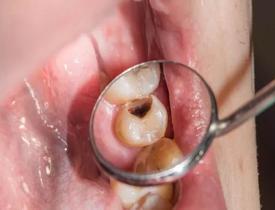 Dişler neden çürür ve önlemek için neler yapabiliriz? 