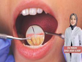 Diş taşı(tartar) olmaması için ne yapılmalı? Diş taşı temizliğinin faydaları nelerdir?