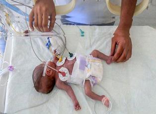 'Mucize bebek' ameliyatla hayatta kalmayı başardı