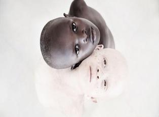 Albinizmli çocukların güzellikleri büyüledi