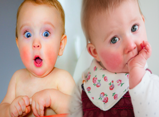Kızarık yanaklı bebeklerde dikkat! Tokatlanmış yanak sendromu ve belirtileri