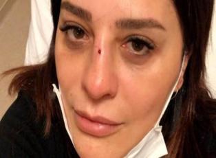 Ünlü şarkıcı Reyhan Karaca bahçeden düşüp burnunu kırdı!