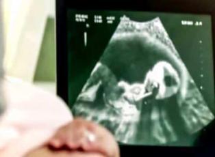 Hamilelikte detaylı ultrason kontrolünün önemi