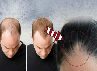 Kellik belirtileri nelerdir? Kellik nasıl önlenir ve saç dökülmesine en etkili tedavi