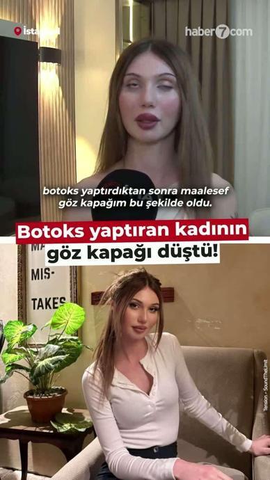 Botoks yaptıran kadının g&ouml;z kapağı d&uuml;şt&uuml;!