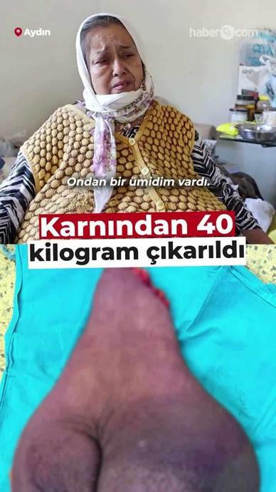 Kadının karnından 40 kiloluk kitle &ccedil;ıkarıldı.