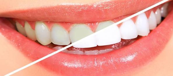Dişlerin dip kısmı neden kararır? Bu karışımla bir haftada dişlerinizi beyazlatın!
